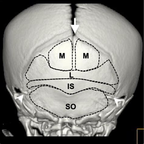 Schematic Representation Of Cranial Sutures In The Occipital Bone