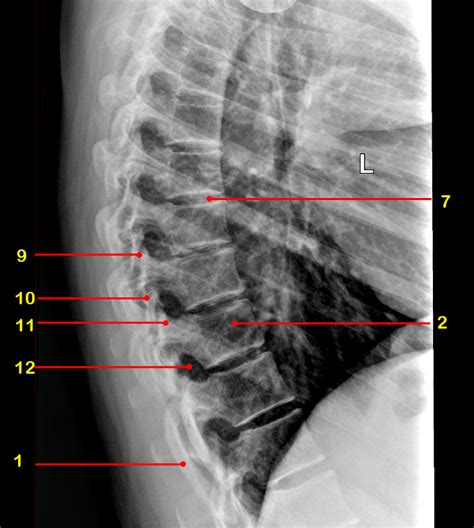 Normal Radiographic Anatomy Of The Thoracic Spine Image
