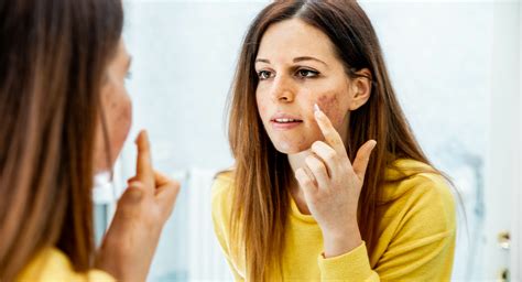 7 Surprising Causes Of Acne Liver Doctor