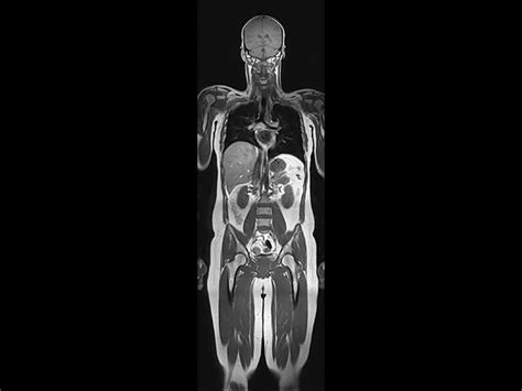 Whole Body Imaging Philips Mr Body Map