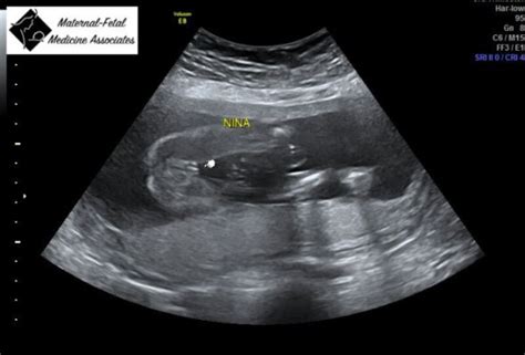 Al cumplir las 22 semanas de embarazo tu bebé desarrolla un importante área cerebral relacionada con las emociones. Ecografías de Niña/Niño por Favor!!! - ♥♠ Club Agosto 2015 ...