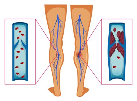Diagram Showing Blood Clot In Human Legs 295800 Vector Art At Vecteezy