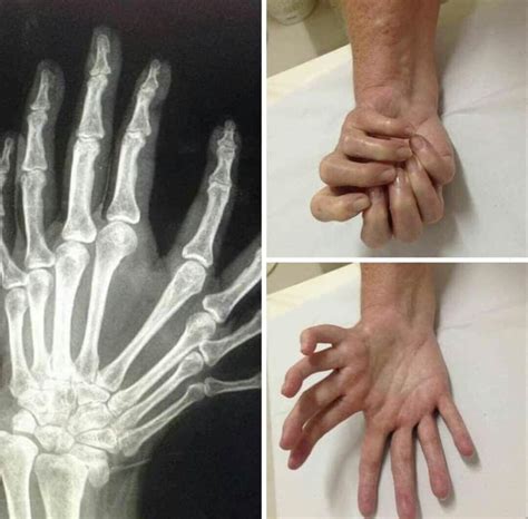 The mirror syndrome is a clinical picture that can manifest itself during pregnancy. This condition is called Mirror Hand Syndrome, less than 100 cases have ever been diagnosed and ...