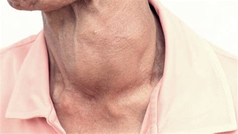 Symptoms Of Thyroid Cancer To Watch Out For Thyroid Symptoms