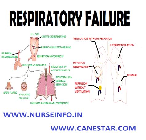 Learn about causes, risk factors, symptoms, diagnosis, and treatments for respiratory failure, and how to participate in clinical. RESPIRATORY FAILURE - Classification, Etiology ...