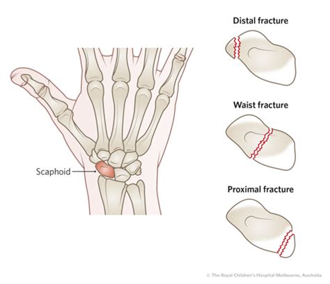 Clinical Practice Guidelines Scaphoid Fractures Emergency Management