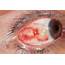 Conjunctival Cyst Photograph By Dr P Marazzi/science Photo Library