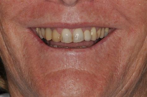 Pictures Of Dental Implants Amazing Before And After Photos