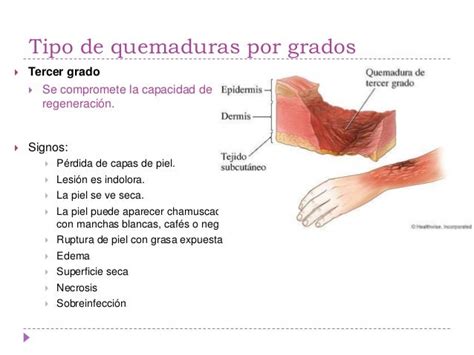 Quemaduras De Tercer Grado