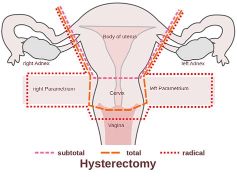 Important Facts About Hysterectomy Urology Specialist