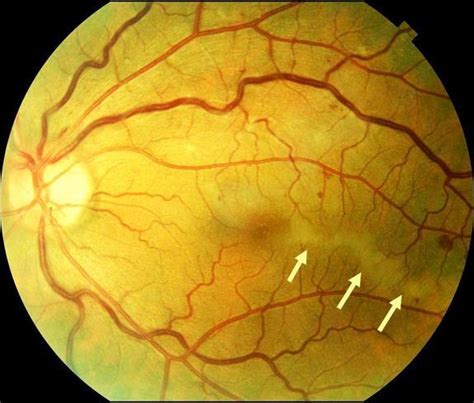 Central Retinal Vein Occlusion Nonischemic With Watershed Zone