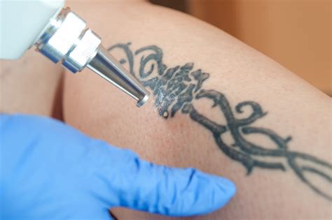 Comment Fonctionne L Enl Vement De Tatouage Au Laser Letranfo