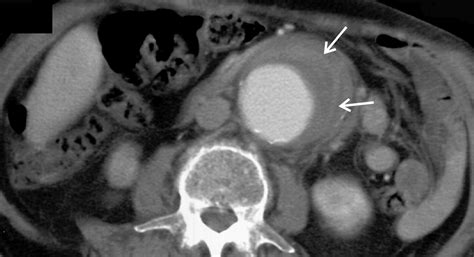 Ct Findings Of Rupture Impending Rupture And Contained Rupture Of