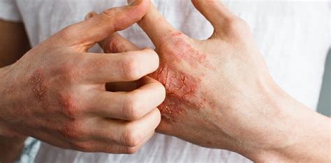 Eczema Skin Clinics