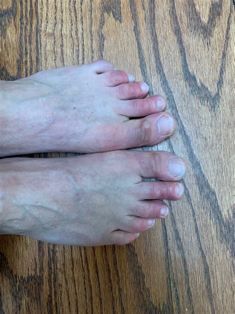 The Afp Community Blog What Are Covid Toes
