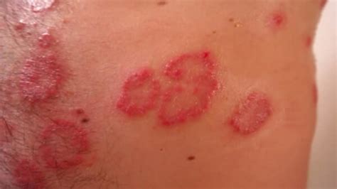 Discoid Eczema Whats Discoid Eczema And How Is It Treated