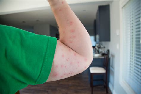 Bed Bug Bites What Are They Phoenix Pest Control And Exterminators