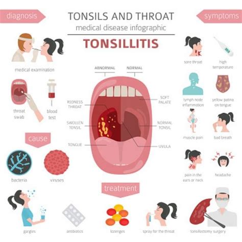 Can You Catch Tonsillitis Signs And Symptoms Of Infection Explained