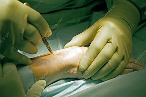 Carpal Tunnel Syndrome Surgery Stock Image M5510438 Science