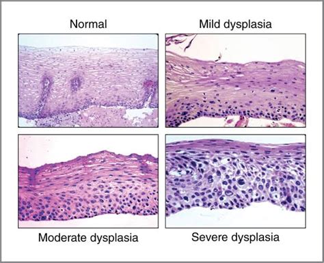 Features Of Epithelial Dysplasia Dentowesome