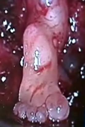 I can offer proof from the medical literature of the 1960s. Fir Tree in Lung,Foot in Foot PhotoEssay - Ramani's blog