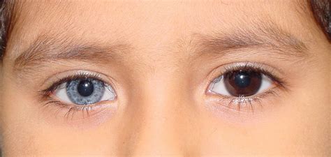 Heterocromia Os Olhos Multicoloridos ~ Mulher Insana