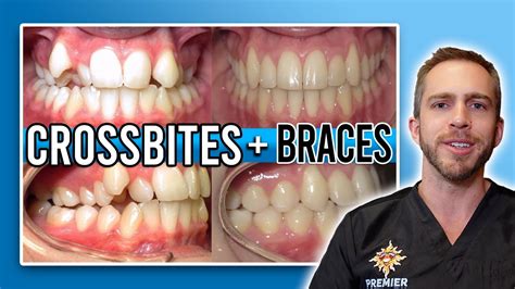 Crossbite Braces Treatment BEFORE AFTER YouTube