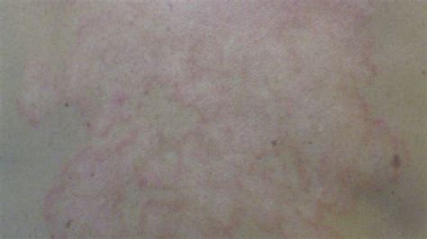 Ringworm Dermatophytosis Or Tinea Symptoms Pictures And Diagnosis
