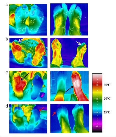 Examples Of Infrared Thermography In Healthy And Disease Conditions