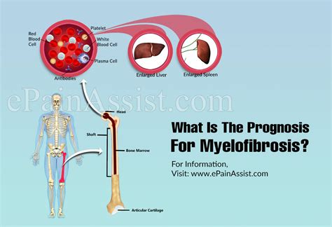 What Is The Prognosis For Myelofibrosis