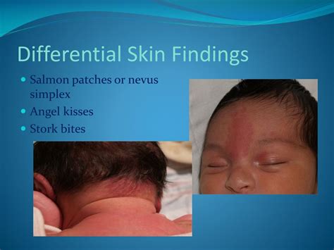 Ppt Neonatal Gestational Age Assessment Powerpoint Presentation Free
