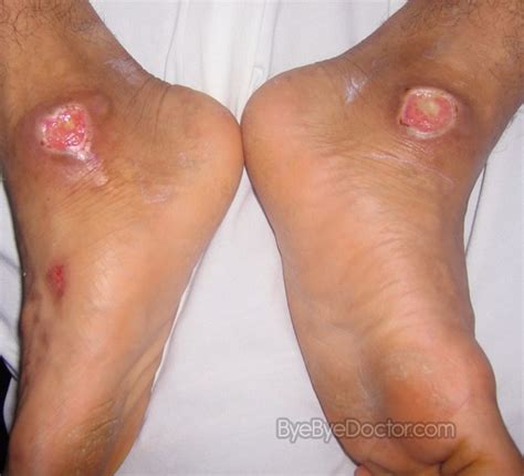 How To Treat Cellulitis Pictures Photos