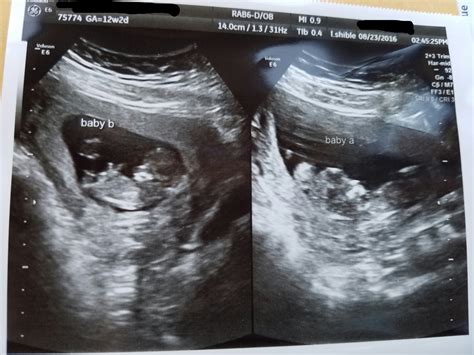 9 Weeks Pregnant Ultrasound Twins