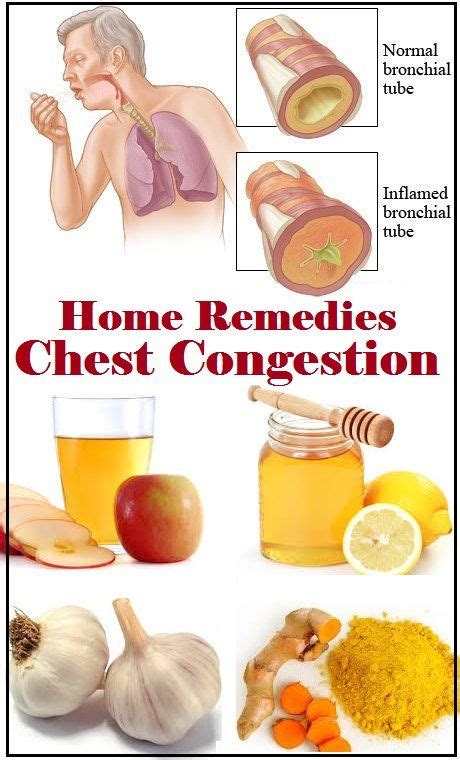 Home Remedies For Chest Congestion Health Remedies Cold Remedies