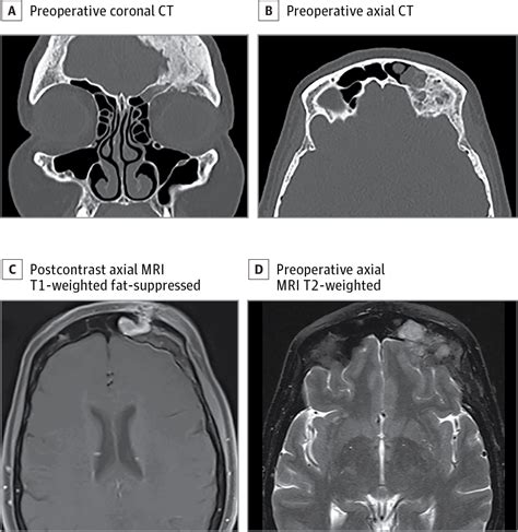 Frontal Sinus Lesion Radiology Jama Otolaryngologyhead And Neck