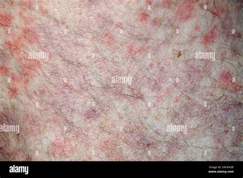 Close Up Of A Purple Rash Purpura On The Skin Of The Leg In A 45 Year