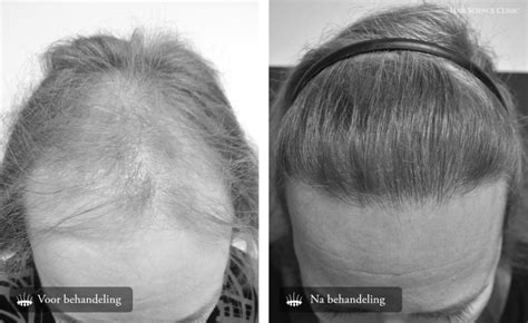 Hair Science Clinics Hair Transplant Before And After Pictures