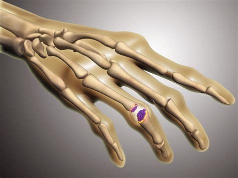 Conceptual Image Of Rheumatoid Arthritis In The Human Hand Ra Is A