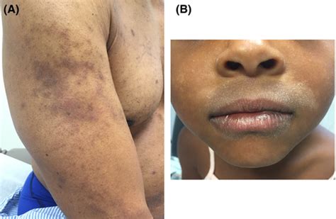 Atopic Dermatitis In Diverse Racial And Ethnic Groups—variations In