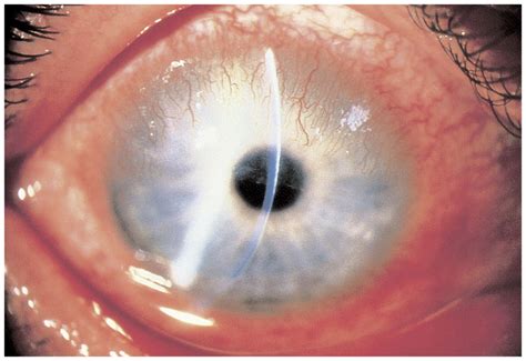 Clinical Approach To Ocular Surface Disorders Ento Key