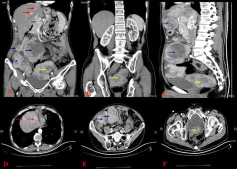 Computed Tomography Ct Revealed Multiple Intrahepatic Recurrent Or