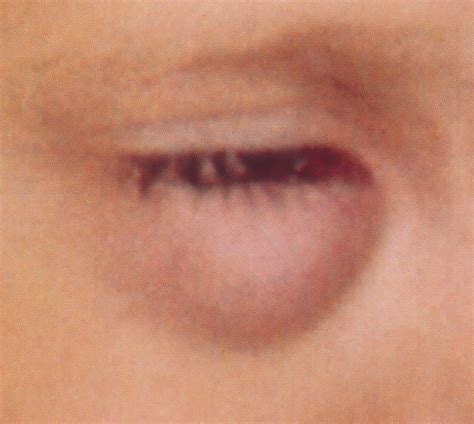 Anterior Orbital Myiasis Caused by Human Botfly ...