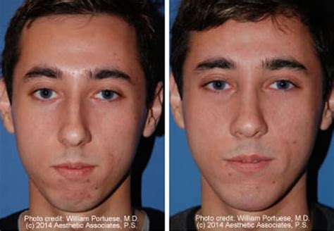 Widening A Narrow Nose Dr William Portuese Facial Plastic Surgeon