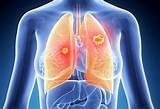 Lung Cancer Treatment In Israel Photos