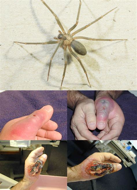 Violin Spider Bite On Hand Spider And Scorpion Of Southern Africa