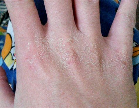 Methylisothiazolinone Reaction Hands Scaling Is A Commo Flickr