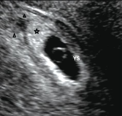 An Intrauterine Gestational Sac With A Double Ring Sign Open I