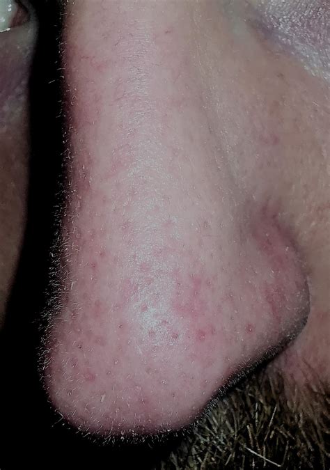 Skin Concerns What Can Be Done About My Nose Skincareaddiction