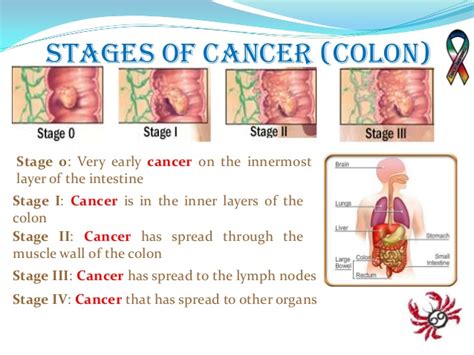 Invasive colorectal cancer is a preventable disease. Cancer