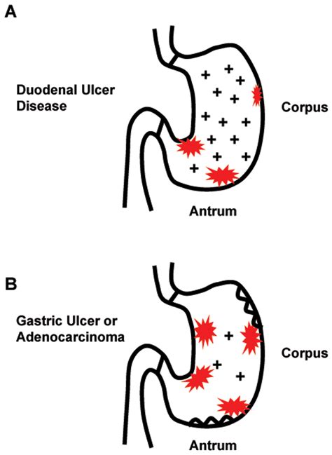 Distinct Pathologies Of H Pyloriinduced Disease A Duodenal Ulcer Download Scientific